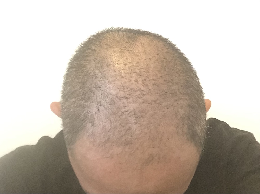 頭皮ケアBefore01