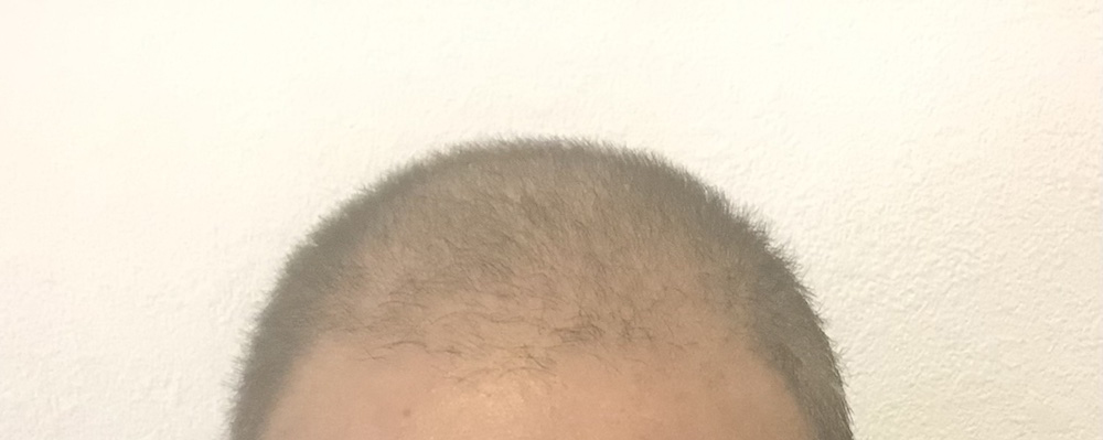 前頭部_頭皮ケアBefore01