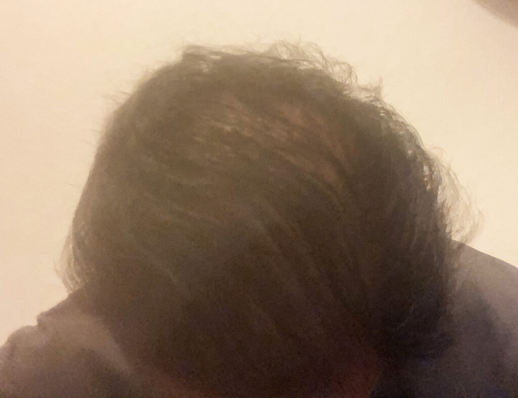 頭頂部_頭皮ケアAfter01