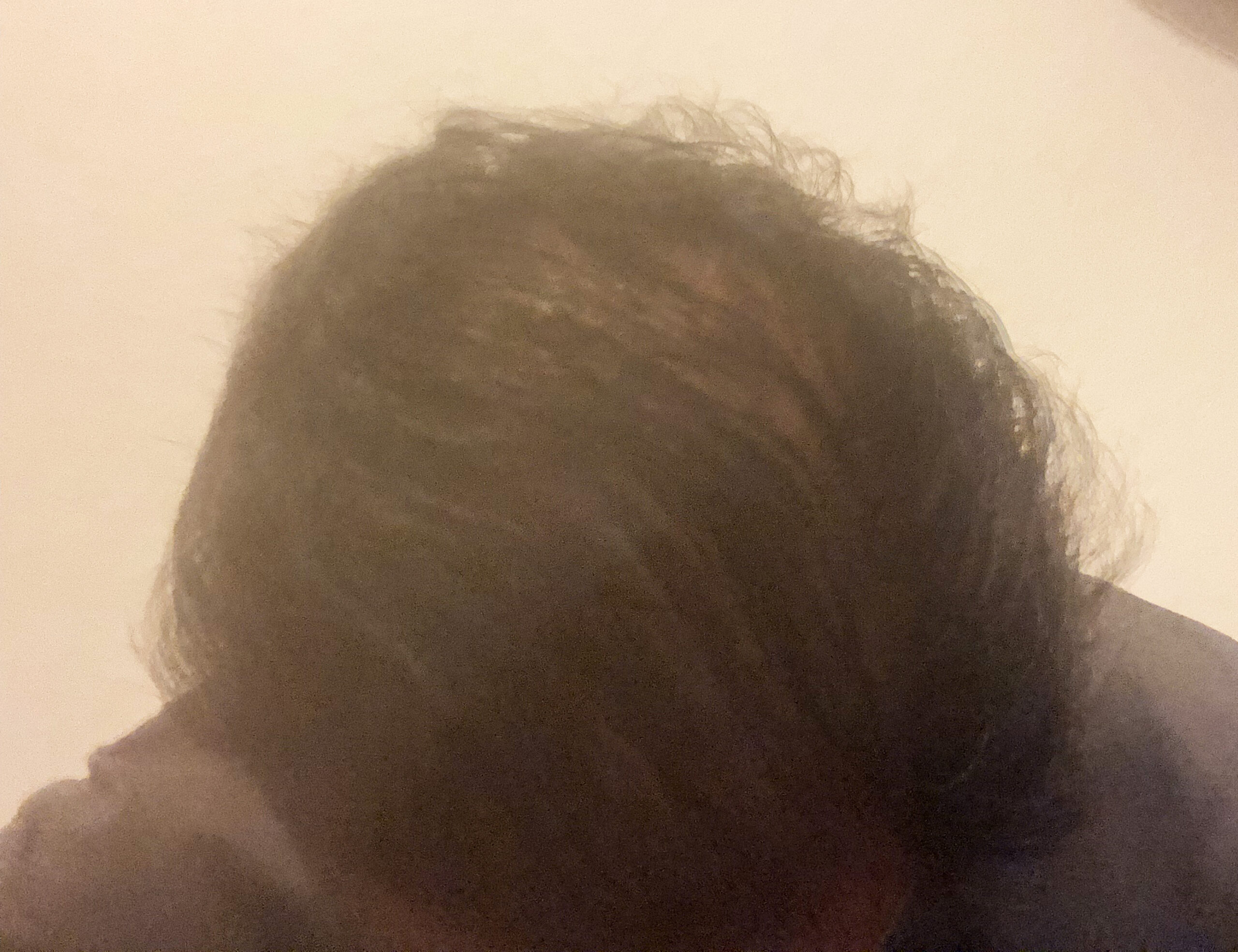 頭頂部_頭皮ケアAfter01