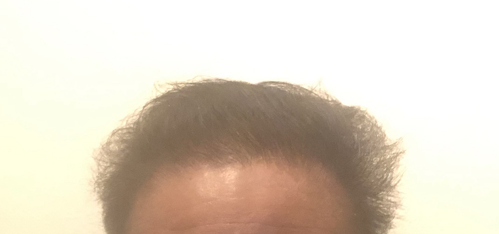 前頭部_頭皮ケアAfter01