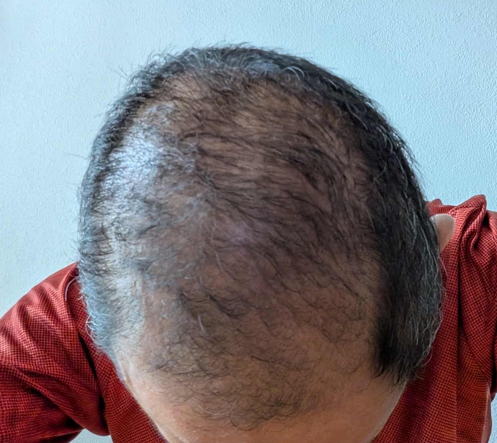 頭頂部_頭皮ケアBefore02