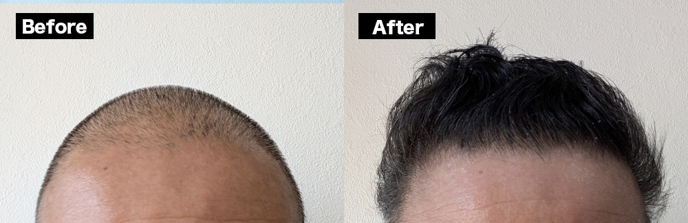 AGA治療効果写真