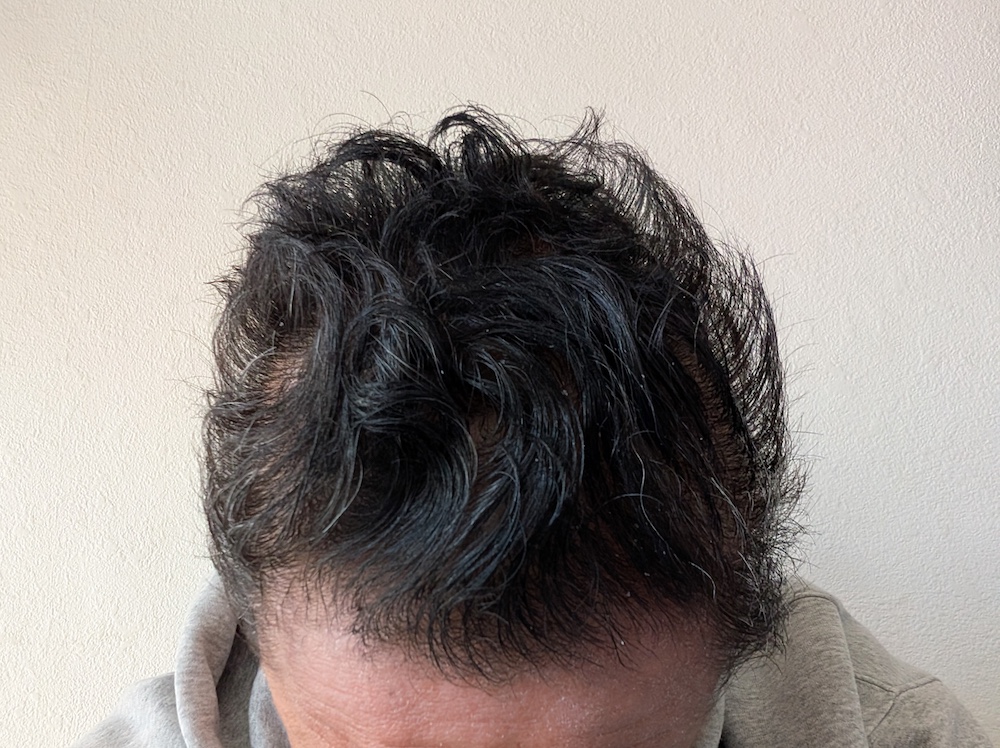頭頂部_頭皮ケアAfter01