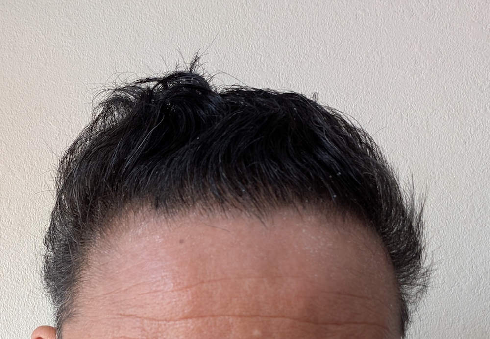 AGA治療5ヶ月目
